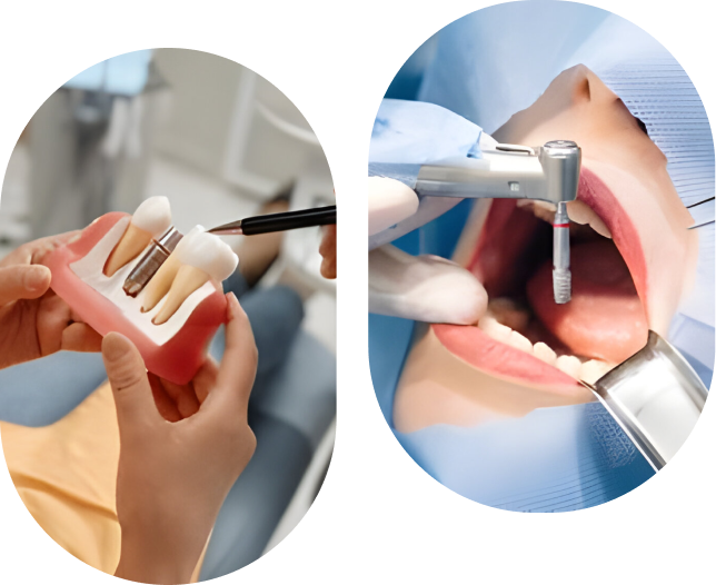 Image d'un implant dentaire placé dans l'os de la mâchoire