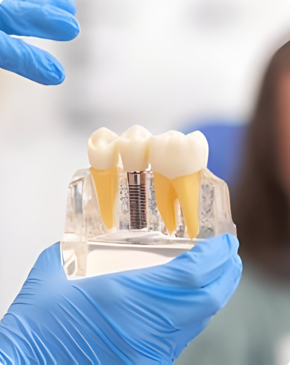 Gros plan sur une mâchoire avec un implant dentaire installé