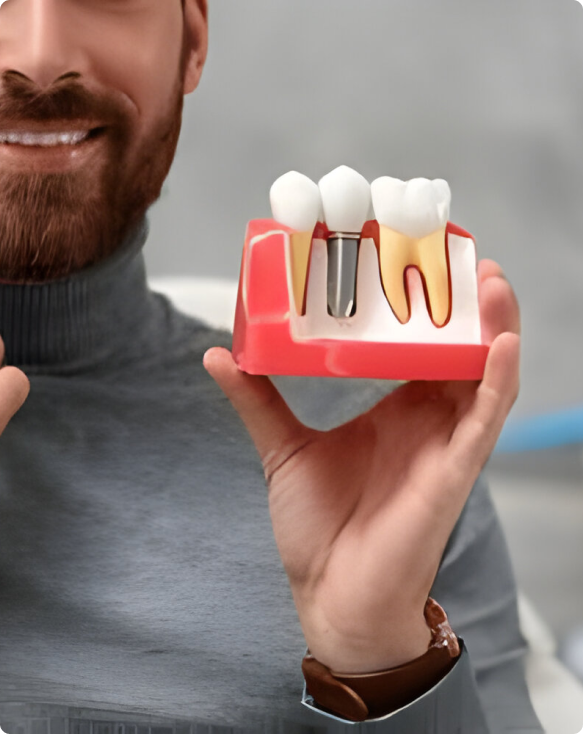 Image illustrant le processus de pose d'un implant dentaire dans la mâchoire