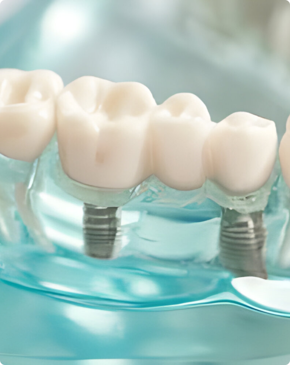 Image illustrant le processus de pose d'un implant dentaire dans la mâchoire